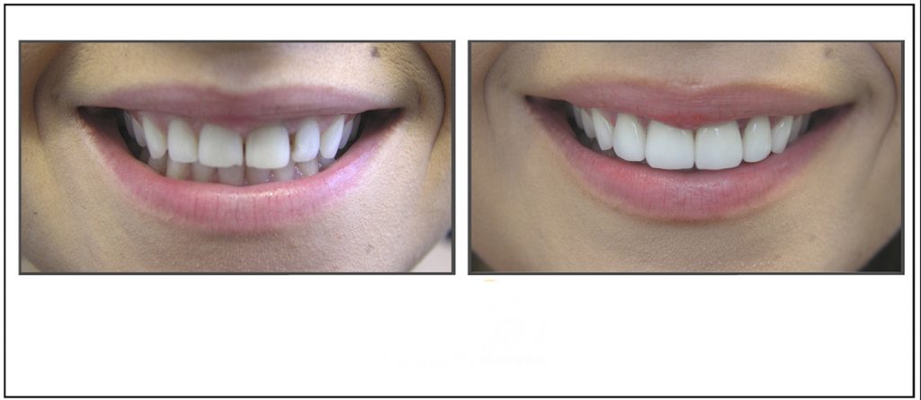 VENEERS---DENTAL-VENEERS--PORCELAIN-VENEERS-MELBOURNE--SPECIALS-AND-PACKAGES