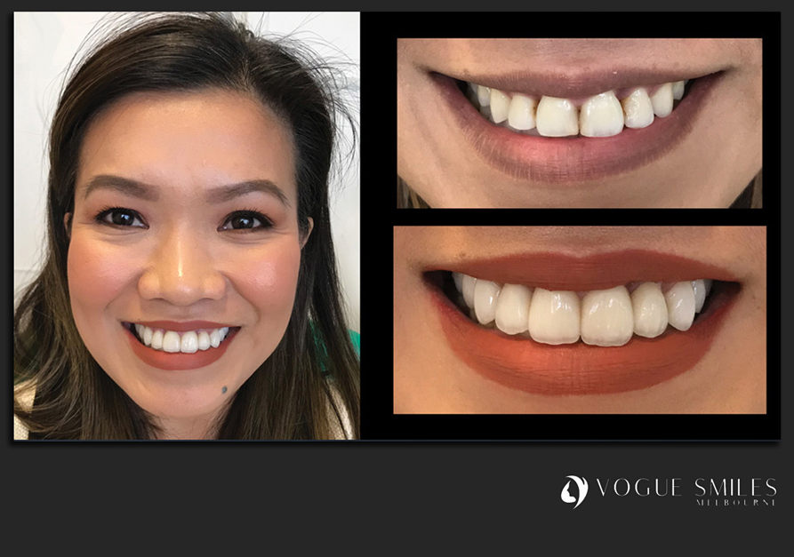 VENEERS---DENTAL-VENEERS--PORCELAIN-VENEERS-MELBOURNE--SPECIALS-AND-PACKAGES