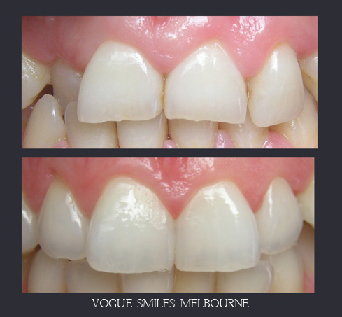 VENEERS---DENTAL-VENEERS--PORCELAIN-VENEERS-MELBOURNE--SPECIALS-AND-PACKAGES