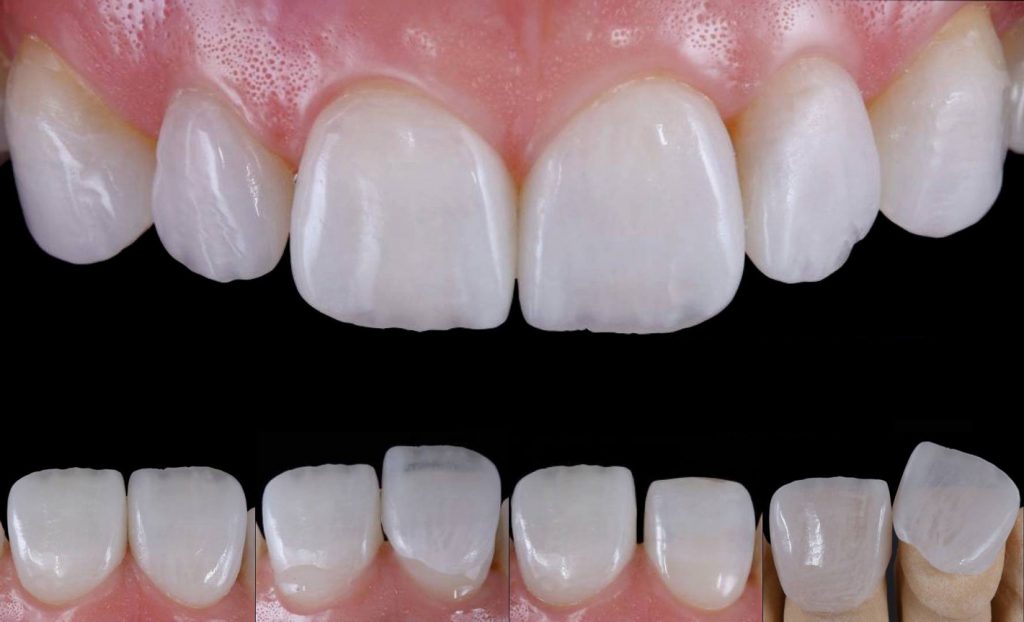 VENEERS---DENTAL-VENEERS--PORCELAIN-VENEERS-MELBOURNE--SPECIALS-AND-PACKAGES