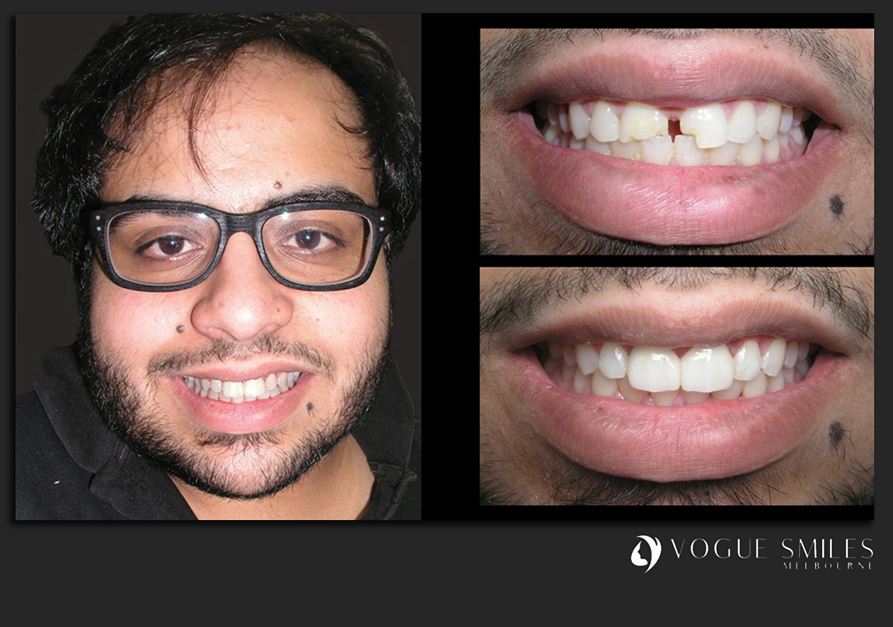 VENEERS---DENTAL-VENEERS--PORCELAIN-VENEERS-MELBOURNE--SPECIALS-AND-PACKAGES
