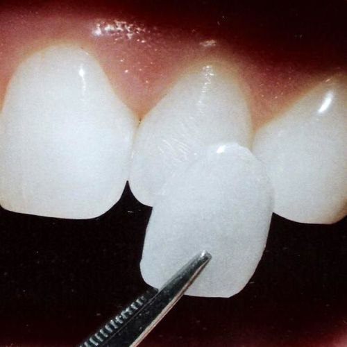 VENEERS---DENTAL-VENEERS--PORCELAIN-VENEERS-MELBOURNE--SPECIALS-AND-PACKAGES