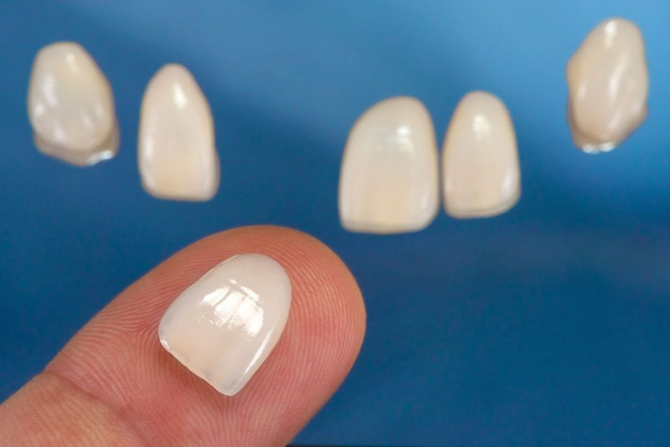 VENEERS---DENTAL-VENEERS--PORCELAIN-VENEERS-MELBOURNE--SPECIALS-AND-PACKAGES