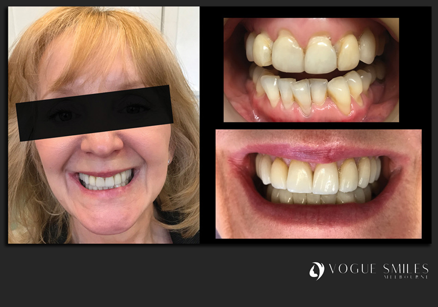 VENEERS---DENTAL-VENEERS--PORCELAIN-VENEERS-MELBOURNE--SPECIALS-AND-PACKAGES