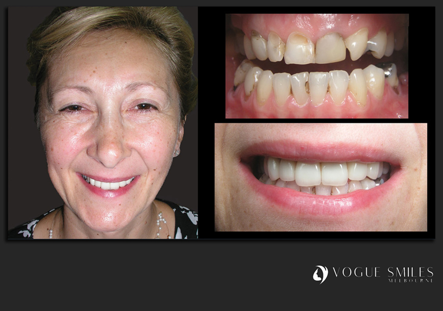 VENEERS---DENTAL-VENEERS--PORCELAIN-VENEERS-MELBOURNE--SPECIALS-AND-PACKAGES