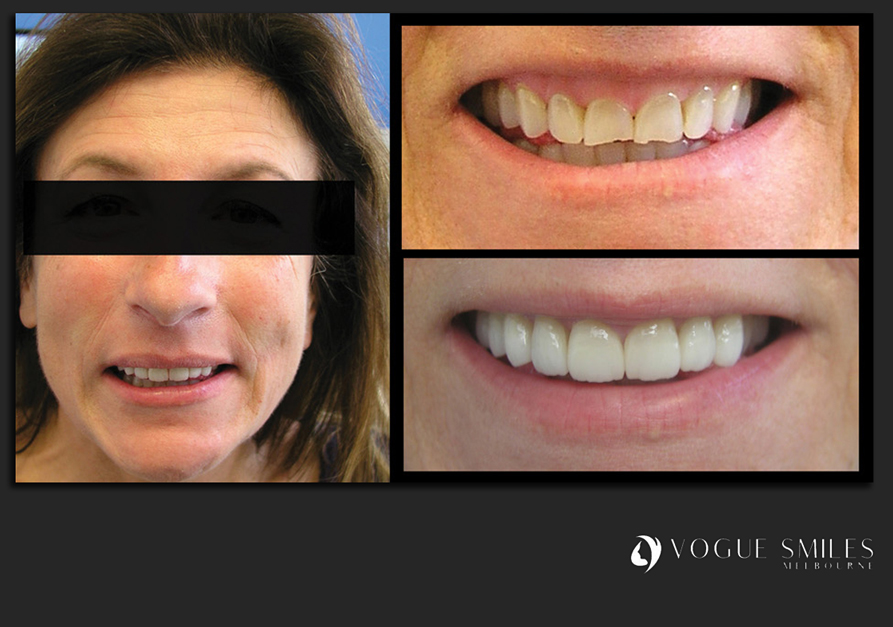 VENEERS---DENTAL-VENEERS--PORCELAIN-VENEERS-MELBOURNE--SPECIALS-AND-PACKAGES
