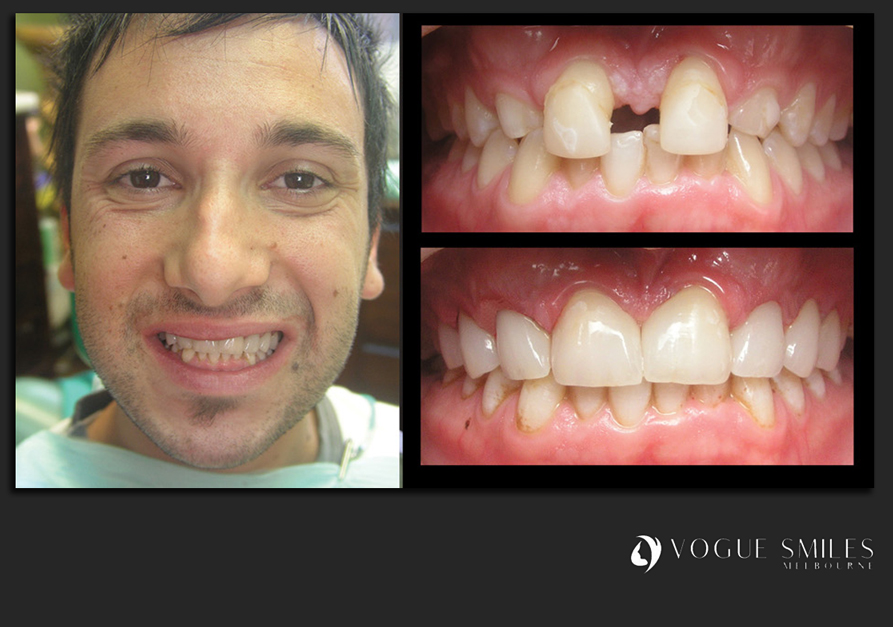 VENEERS---DENTAL-VENEERS--PORCELAIN-VENEERS-MELBOURNE--SPECIALS-AND-PACKAGES