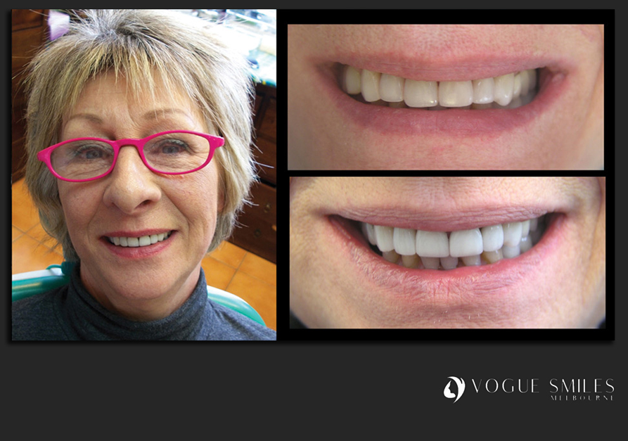 VENEERS---DENTAL-VENEERS--PORCELAIN-VENEERS-MELBOURNE--SPECIALS-AND-PACKAGES
