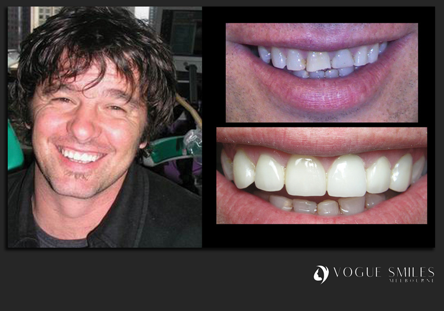 VENEERS---DENTAL-VENEERS--PORCELAIN-VENEERS-MELBOURNE--SPECIALS-AND-PACKAGES