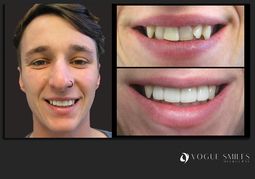 VENEERS---DENTAL-VENEERS--PORCELAIN-VENEERS-MELBOURNE--SPECIALS-AND-PACKAGES
