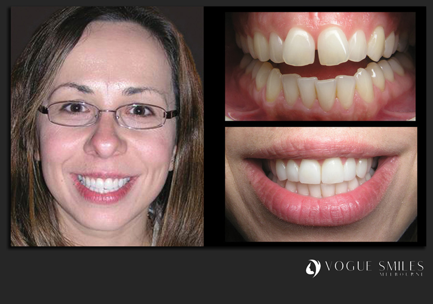 VENEERS---DENTAL-VENEERS--PORCELAIN-VENEERS-MELBOURNE--SPECIALS-AND-PACKAGES