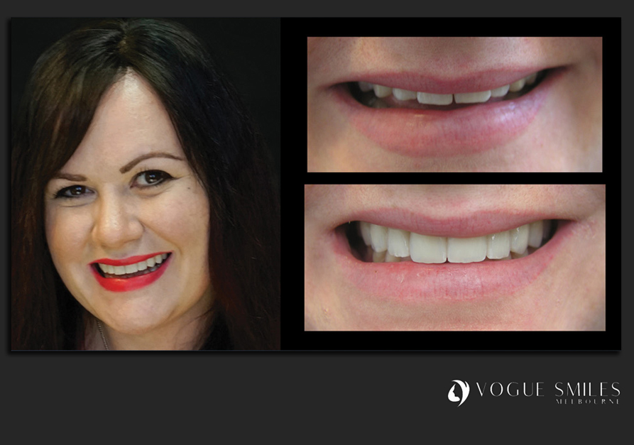 VENEERS---DENTAL-VENEERS--PORCELAIN-VENEERS-MELBOURNE--SPECIALS-AND-PACKAGES