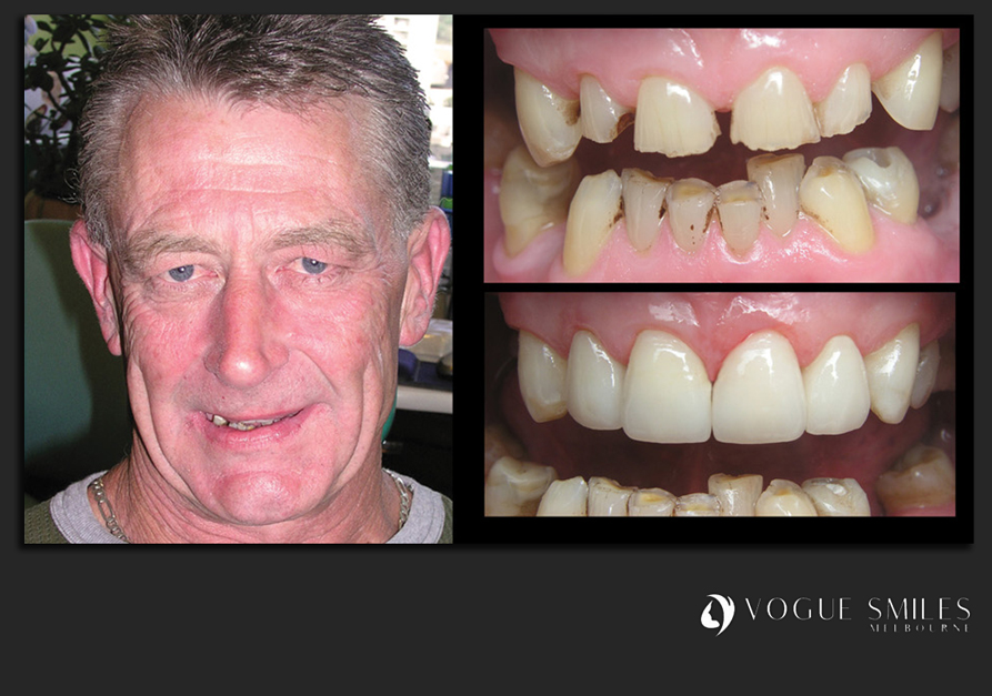 VENEERS---DENTAL-VENEERS--PORCELAIN-VENEERS-MELBOURNE--SPECIALS-AND-PACKAGES