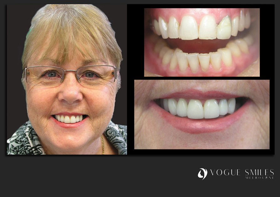 VENEERS---DENTAL-VENEERS--PORCELAIN-VENEERS-MELBOURNE--SPECIALS-AND-PACKAGES