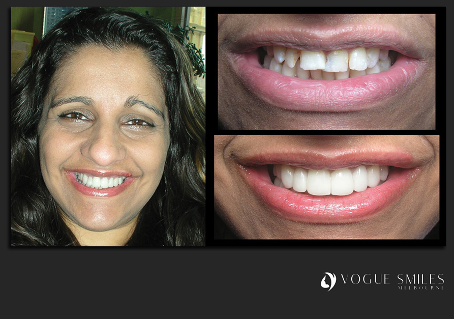 VENEERS---DENTAL-VENEERS--PORCELAIN-VENEERS-MELBOURNE--SPECIALS-AND-PACKAGES