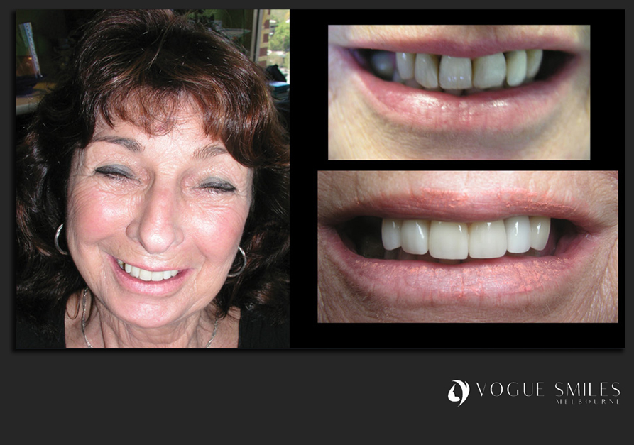 VENEERS---DENTAL-VENEERS--PORCELAIN-VENEERS-MELBOURNE--SPECIALS-AND-PACKAGES