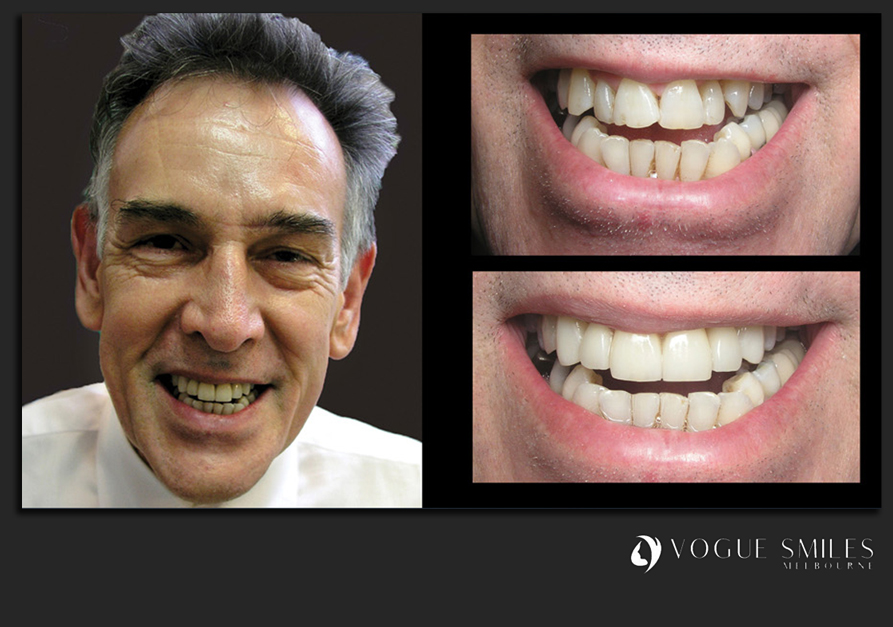 VENEERS---DENTAL-VENEERS--PORCELAIN-VENEERS-MELBOURNE--SPECIALS-AND-PACKAGES