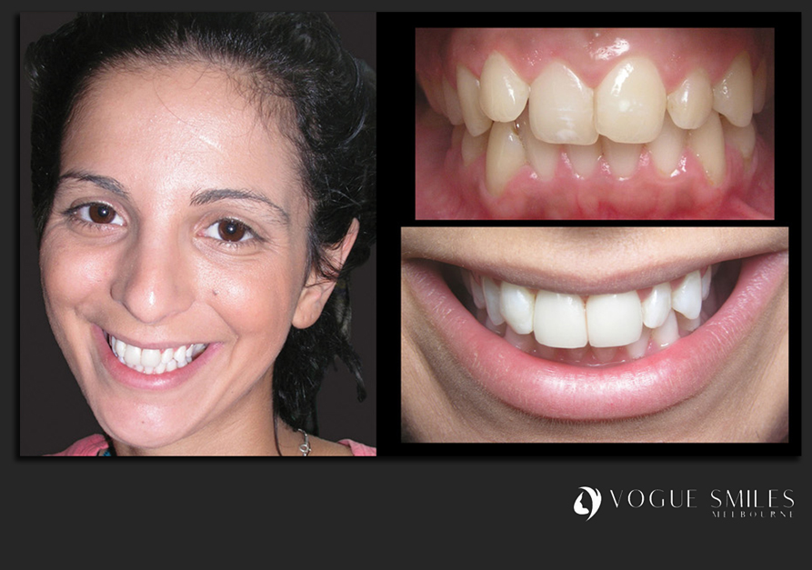 VENEERS---DENTAL-VENEERS--PORCELAIN-VENEERS-MELBOURNE--SPECIALS-AND-PACKAGES