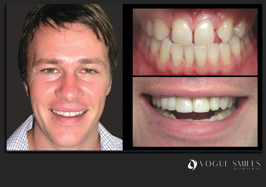 VENEERS---DENTAL-VENEERS--PORCELAIN-VENEERS-MELBOURNE--SPECIALS-AND-PACKAGES