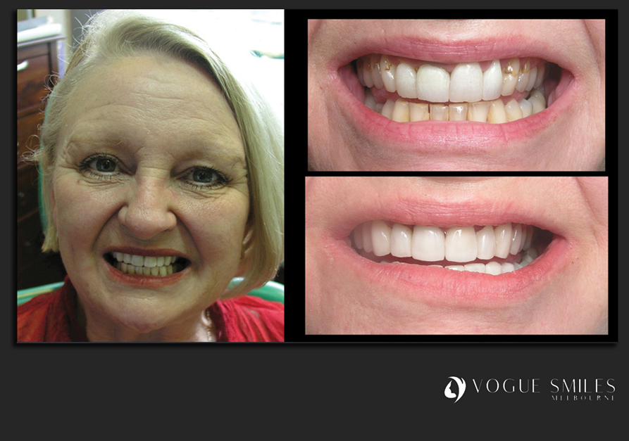 VENEERS---DENTAL-VENEERS--PORCELAIN-VENEERS-MELBOURNE--SPECIALS-AND-PACKAGES