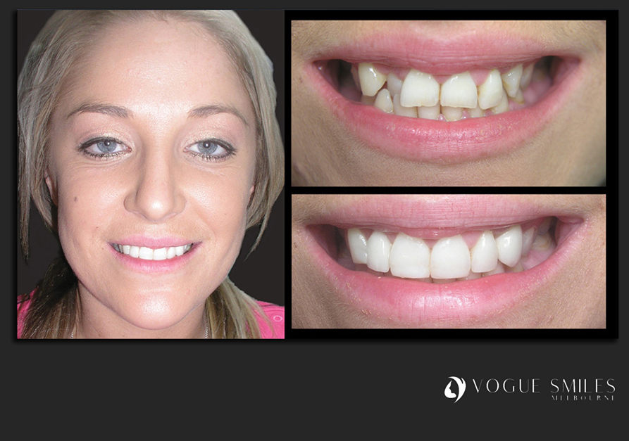VENEERS---DENTAL-VENEERS--PORCELAIN-VENEERS-MELBOURNE--SPECIALS-AND-PACKAGES