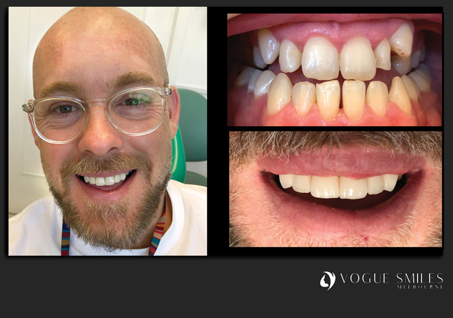 VENEERS---DENTAL-VENEERS--PORCELAIN-VENEERS-MELBOURNE--SPECIALS-AND-PACKAGES