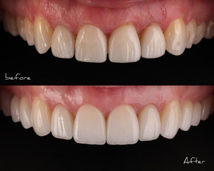 VENEERS---DENTAL-VENEERS--PORCELAIN-VENEERS-MELBOURNE--SPECIALS-AND-PACKAGES