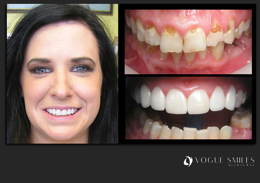 VENEERS---DENTAL-VENEERS--PORCELAIN-VENEERS-MELBOURNE--SPECIALS-AND-PACKAGES