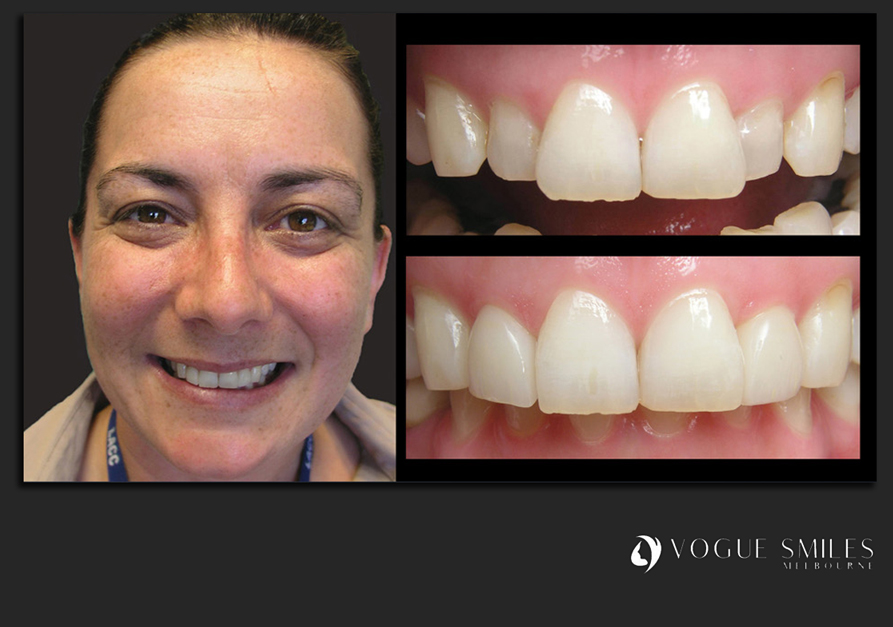 VENEERS---DENTAL-VENEERS--PORCELAIN-VENEERS-MELBOURNE--SPECIALS-AND-PACKAGES