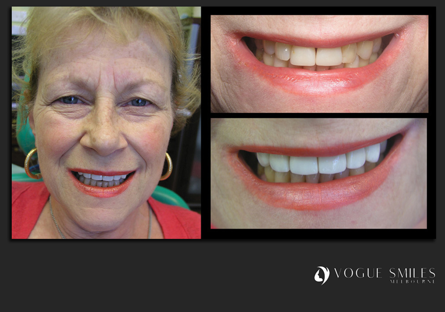 VENEERS---DENTAL-VENEERS--PORCELAIN-VENEERS-MELBOURNE--SPECIALS-AND-PACKAGES