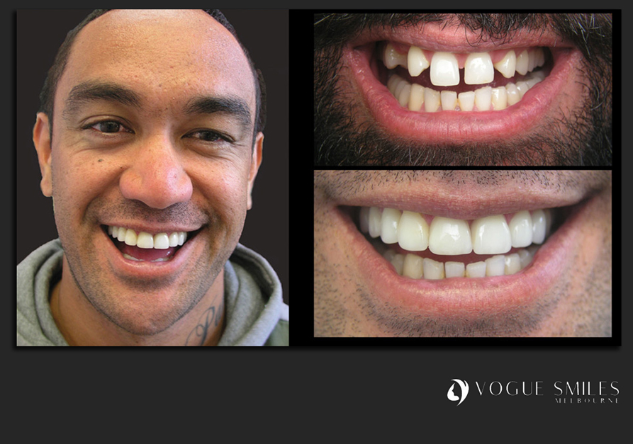 VENEERS---DENTAL-VENEERS--PORCELAIN-VENEERS-MELBOURNE--SPECIALS-AND-PACKAGES