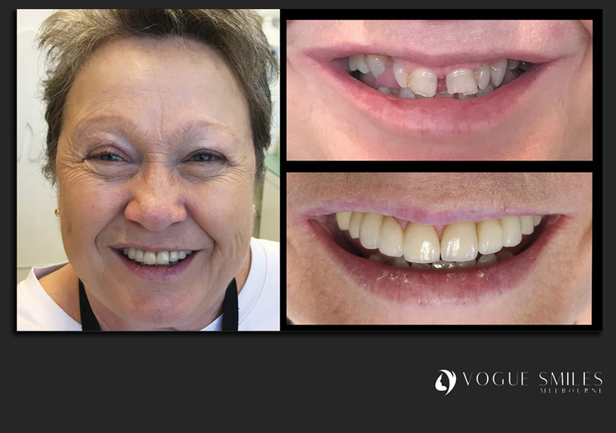 VENEERS---DENTAL-VENEERS--PORCELAIN-VENEERS-MELBOURNE--SPECIALS-AND-PACKAGES