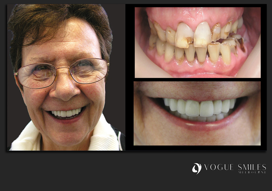 VENEERS---DENTAL-VENEERS--PORCELAIN-VENEERS-MELBOURNE--SPECIALS-AND-PACKAGES