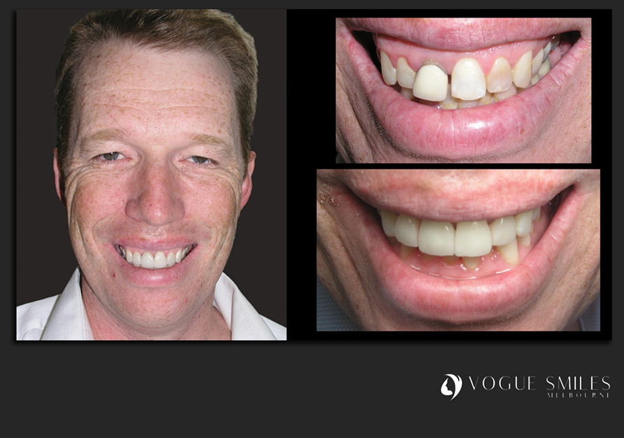 VENEERS---DENTAL-VENEERS--PORCELAIN-VENEERS-MELBOURNE--SPECIALS-AND-PACKAGES