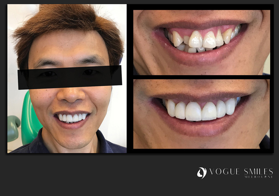 VENEERS---DENTAL-VENEERS--PORCELAIN-VENEERS-MELBOURNE--SPECIALS-AND-PACKAGES