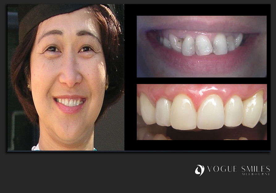 VENEERS---DENTAL-VENEERS--PORCELAIN-VENEERS-MELBOURNE--SPECIALS-AND-PACKAGES