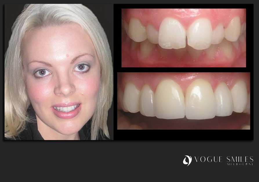 VENEERS---DENTAL-VENEERS--PORCELAIN-VENEERS-MELBOURNE--SPECIALS-AND-PACKAGES