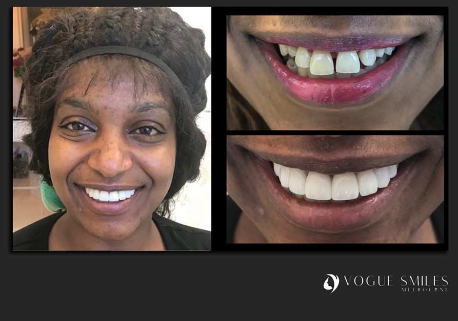 VENEERS---DENTAL-VENEERS--PORCELAIN-VENEERS-MELBOURNE--SPECIALS-AND-PACKAGES