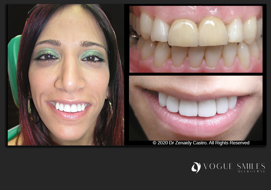 VENEERS---DENTAL-VENEERS--PORCELAIN-VENEERS-MELBOURNE--SPECIALS-AND-PACKAGES
