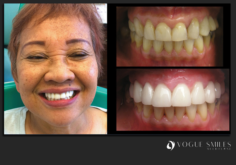 VENEERS---DENTAL-VENEERS--PORCELAIN-VENEERS-MELBOURNE--SPECIALS-AND-PACKAGES