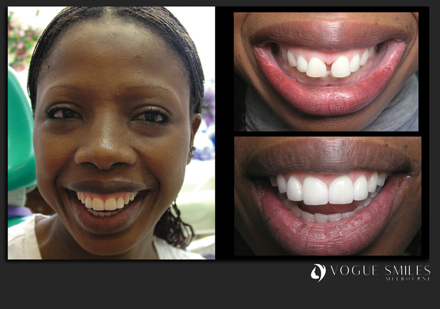 VENEERS---DENTAL-VENEERS--PORCELAIN-VENEERS-MELBOURNE--SPECIALS-AND-PACKAGES