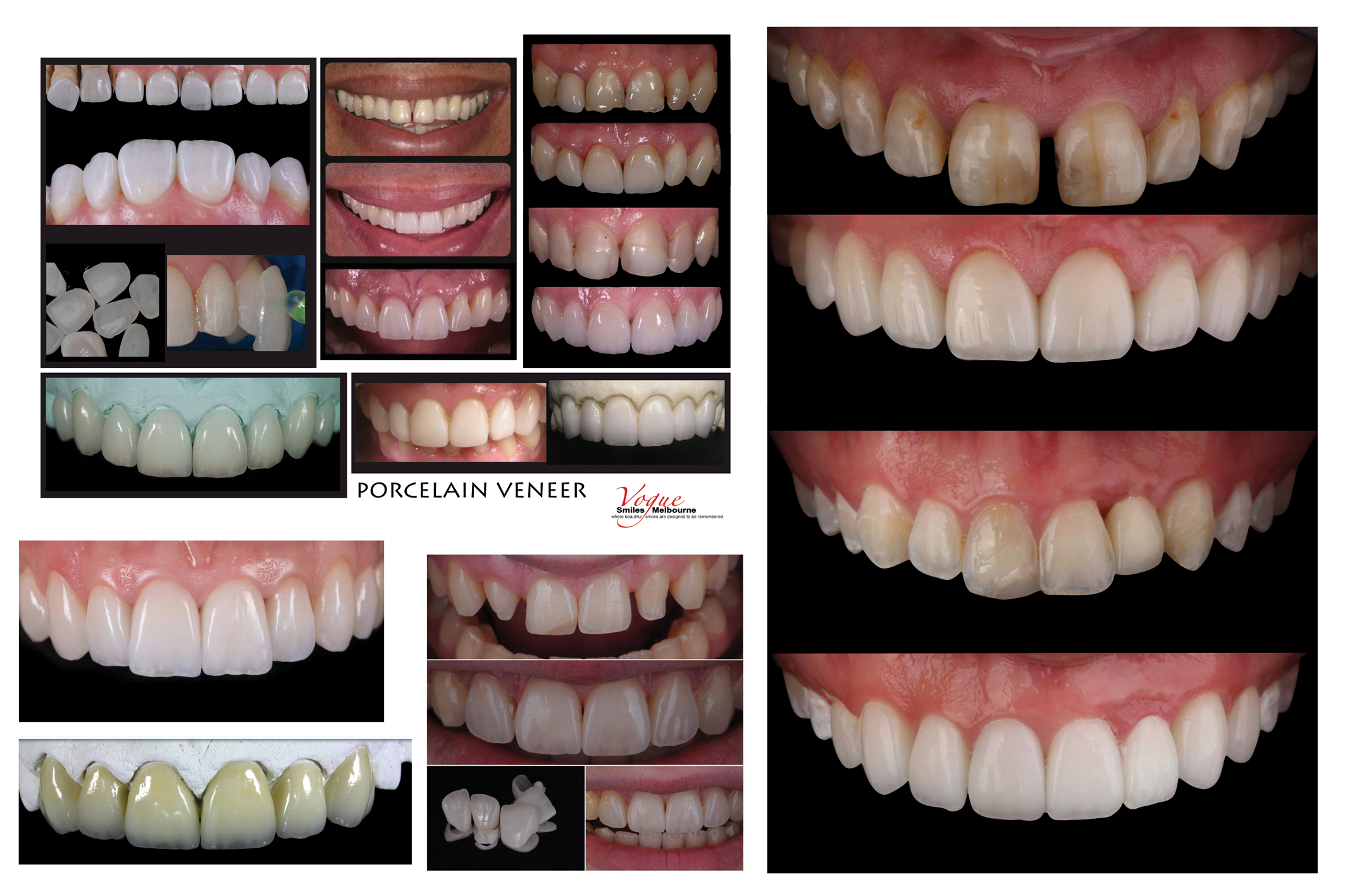 VENEERS---DENTAL-VENEERS--PORCELAIN-VENEERS-MELBOURNE--SPECIALS-AND-PACKAGES