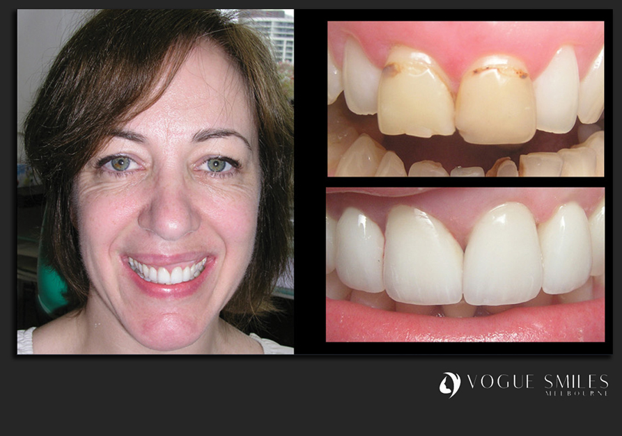 VENEERS---DENTAL-VENEERS--PORCELAIN-VENEERS-MELBOURNE--SPECIALS-AND-PACKAGES