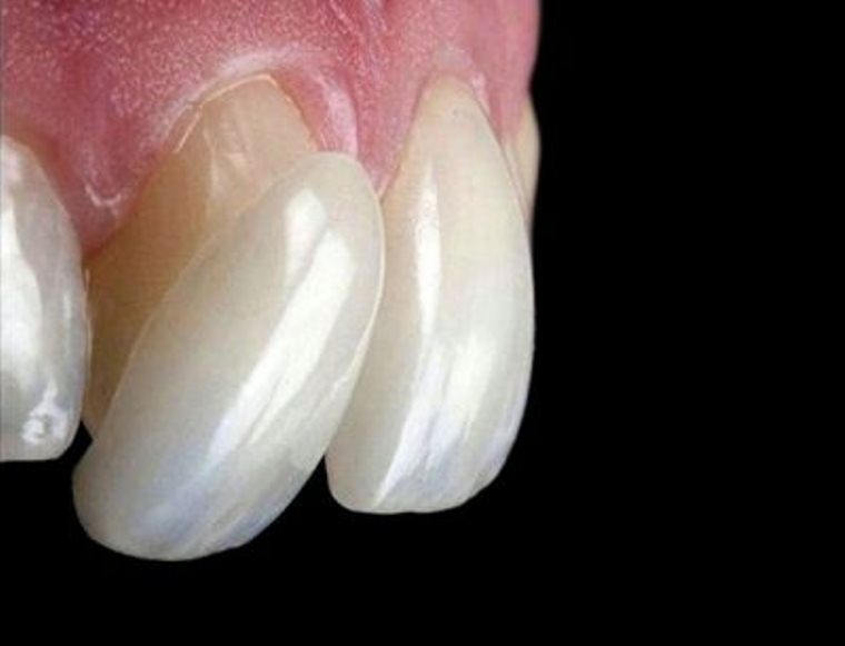 VENEERS---DENTAL-VENEERS--PORCELAIN-VENEERS-MELBOURNE--SPECIALS-AND-PACKAGES