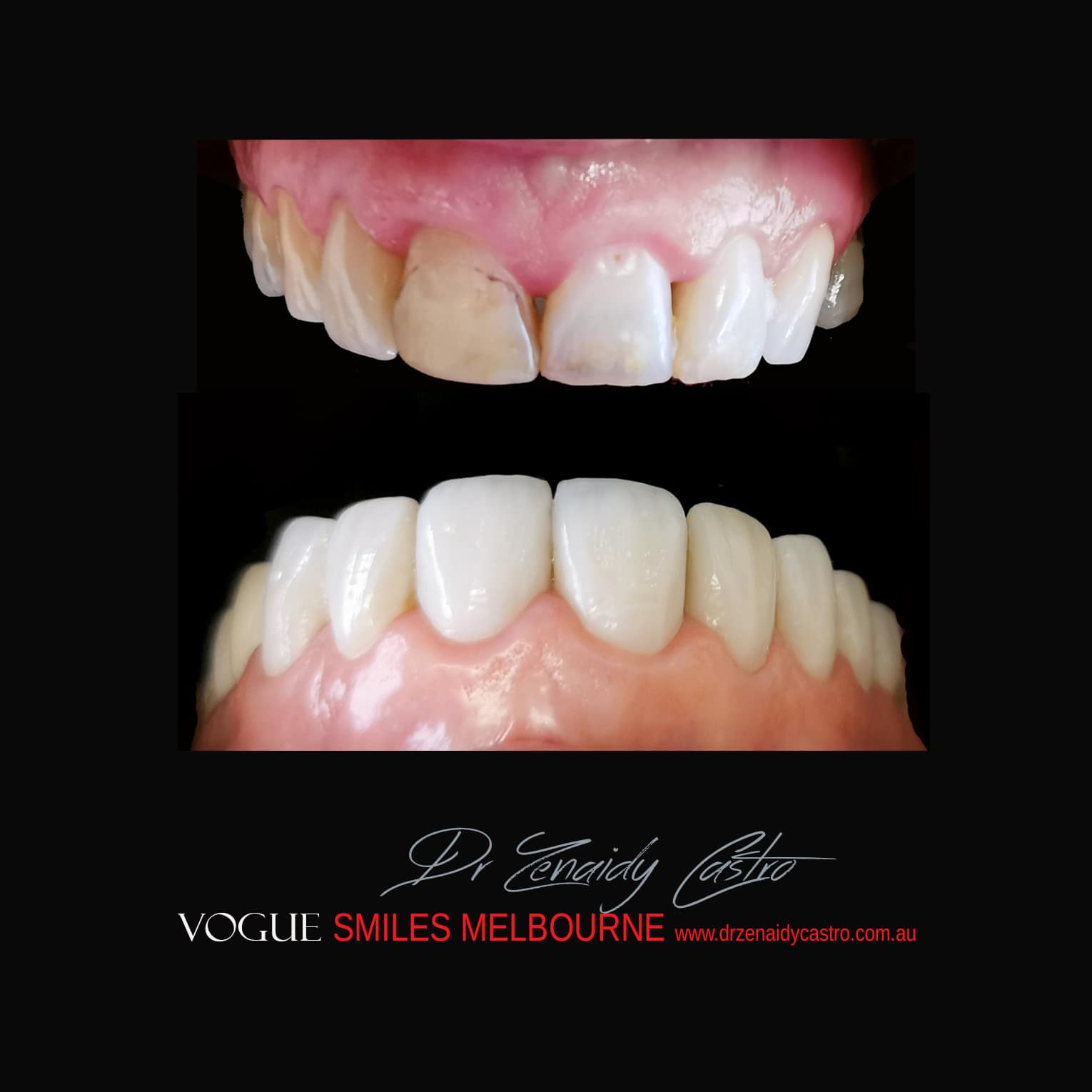 Porcelain-Veneers-in-Mlebourne-CBD-Before-and-After-gallery-1.jpg