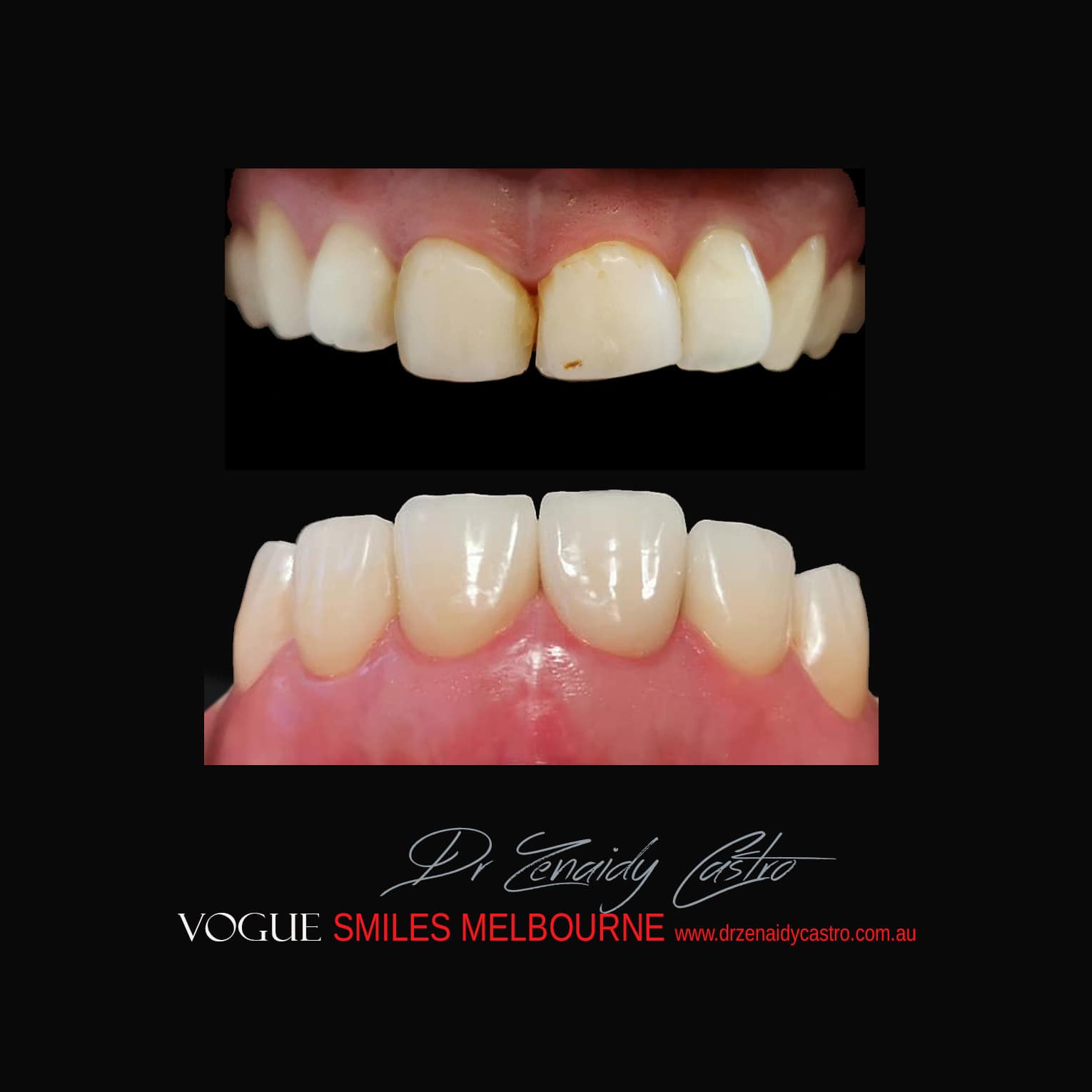 Porcelain-Veneers-in-Mlebourne-CBD-Before-and-After-gallery-10.jpg