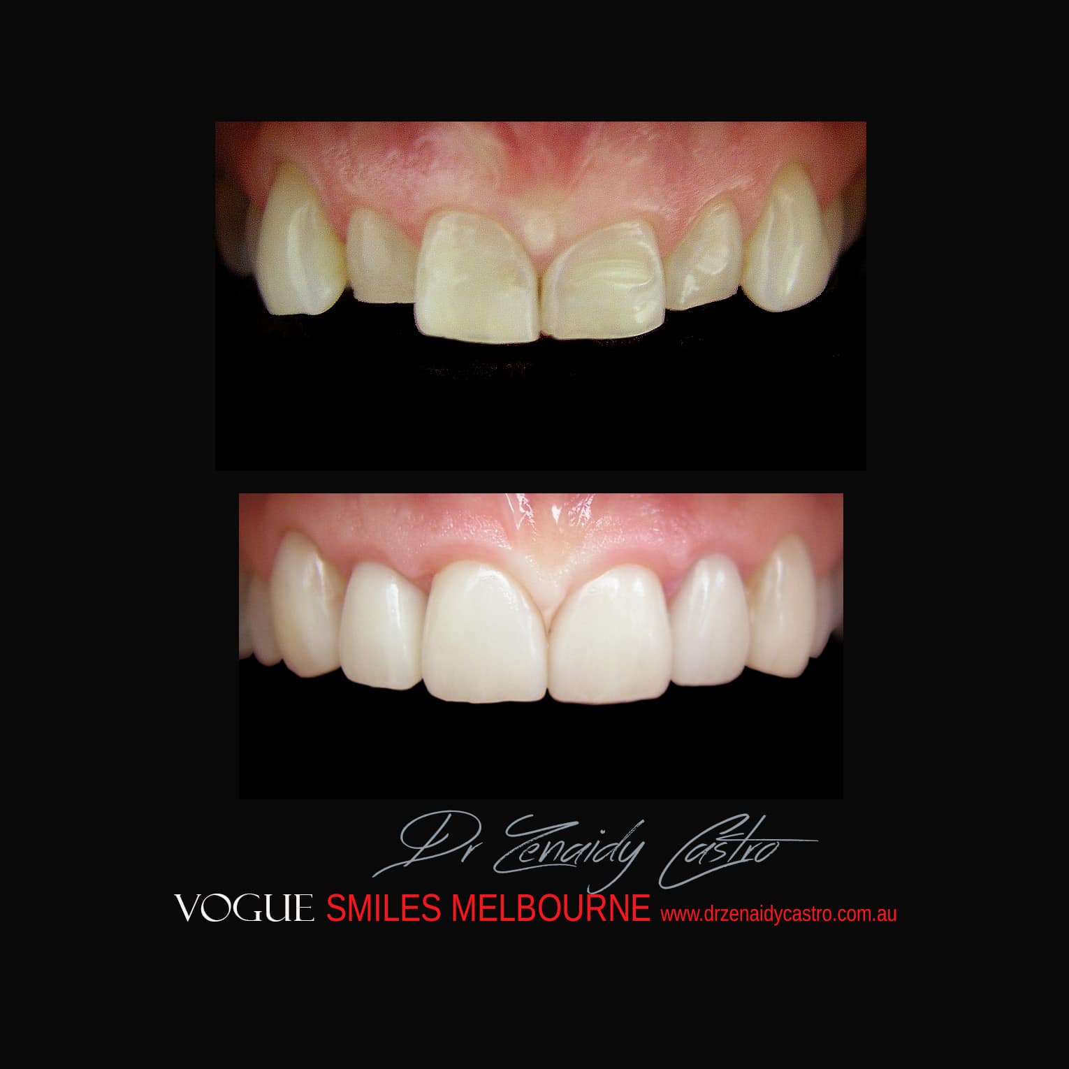 Porcelain-Veneers-in-Mlebourne-CBD-Before-and-After-gallery-11.jpg