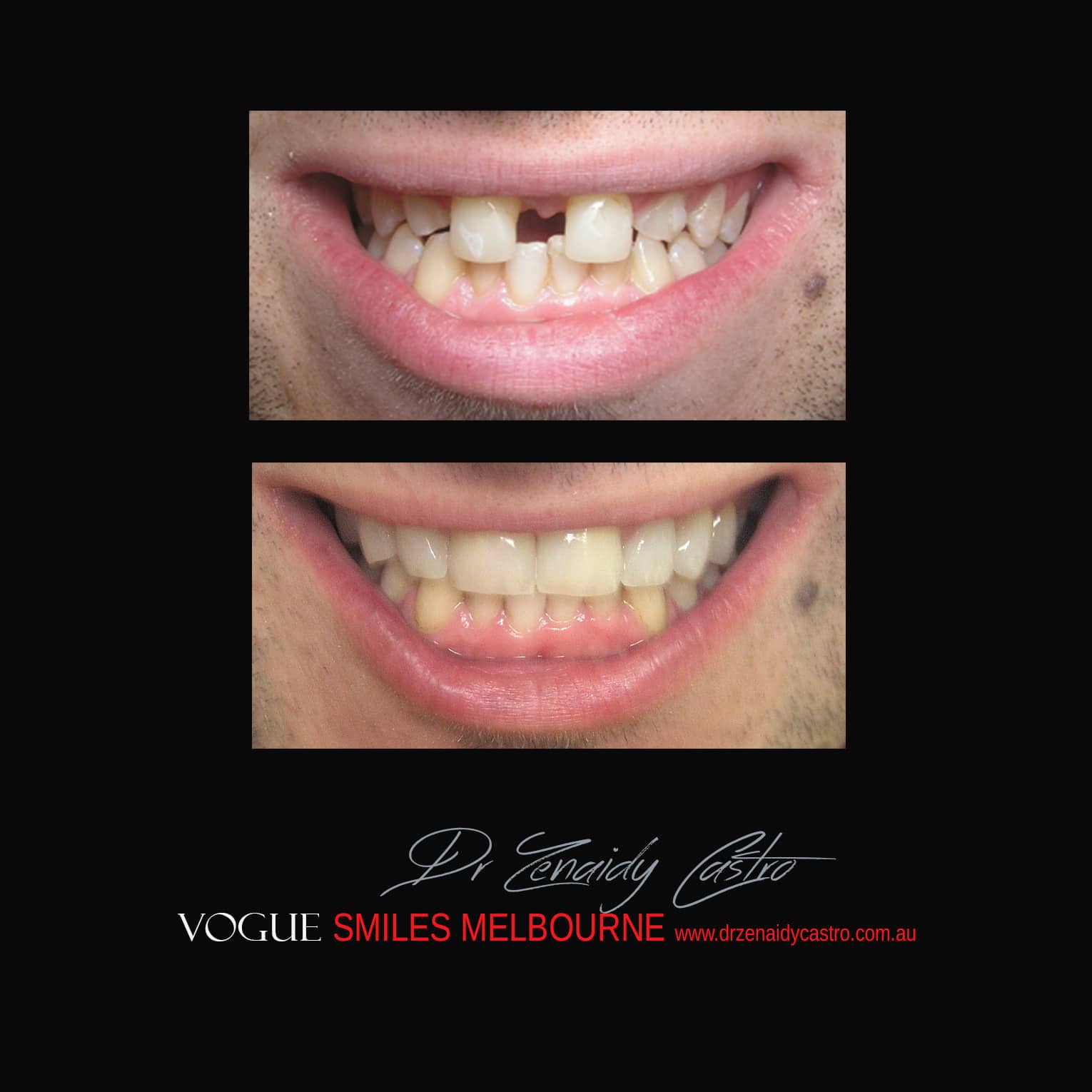 Porcelain-Veneers-in-Mlebourne-CBD-Before-and-After-gallery-2.jpg