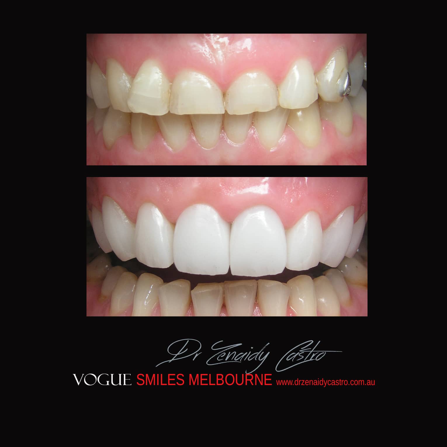 Porcelain-Veneers-in-Mlebourne-CBD-Before-and-After-gallery-3.jpg