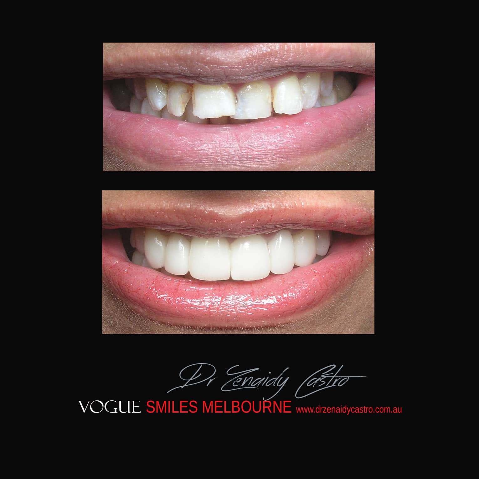 Porcelain-Veneers-in-Mlebourne-CBD-Before-and-After-gallery-4.jpg